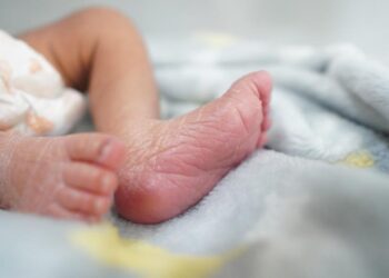 Talla baja y cuello ancho pueden ser señales del Síndrome de Turner: SSO