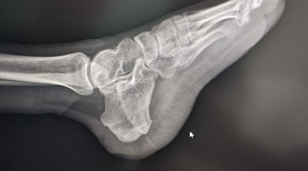 Después de 7 años, cuenta Hospital de Tuxtepec con nueva Unidad Radiológica Digital para estudios de Tórax