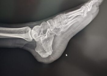 Después de 7 años, cuenta Hospital de Tuxtepec con nueva Unidad Radiológica Digital para estudios de Tórax